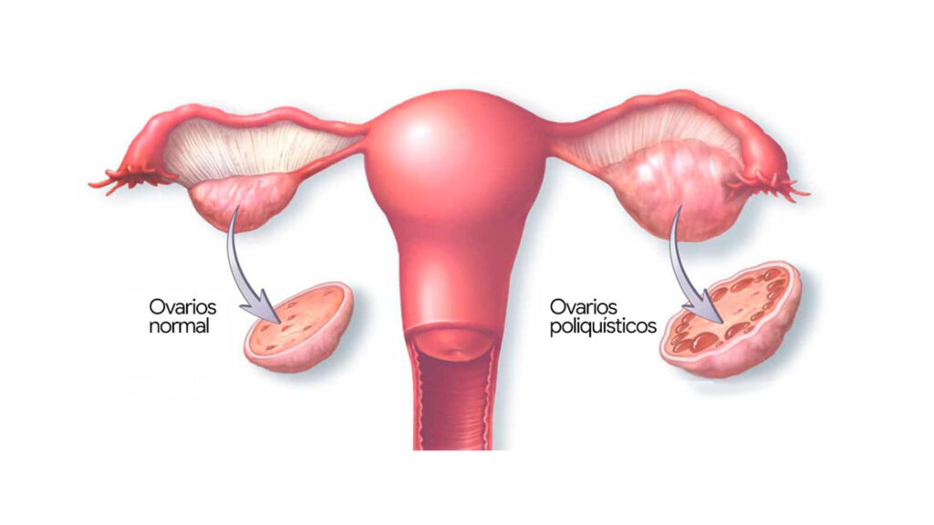 Síndrome del Ovario Poliquístico  Lights Magazine